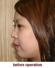 plastic_surgery_augmentation_rhinoplasty