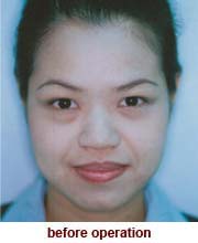 plastic_surgery_augmentation_rhinoplasty