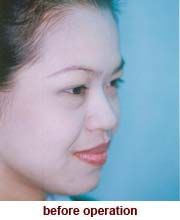 plastic_surgery_augmentation_rhinoplasty