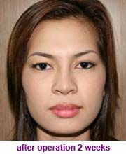 plastic_surgery_augmentation_rhinoplasty