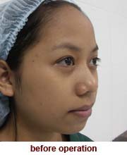 plastic_surgery_augmentation_rhinoplasty