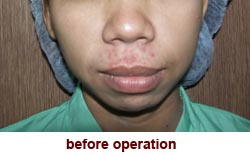 plastic-surgery-chin-augmentation