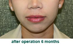plastic-surgery-chin-augmentation