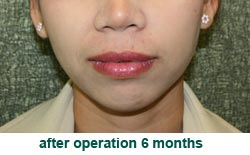 plastic-surgery-chin-augmentation