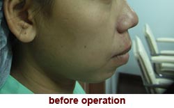 plastic-surgery-chin-augmentation