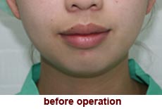 plastic-surgery-chin-augmentation