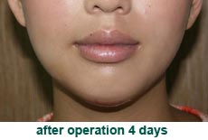 plastic-surgery-chin-augmentation