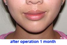 plastic-surgery-chin-augmentation