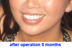 plastic-surgery-chin-augmentation