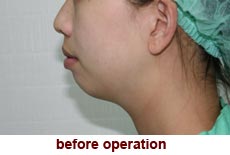 plastic-surgery-chin-augmentation