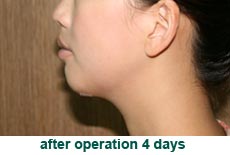 plastic-surgery-chin-augmentation