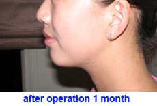 plastic-surgery-chin-augmentation