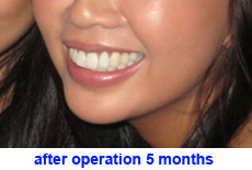 plastic-surgery-chin-augmentation