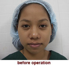 plastic-surgery-chin-augmentation