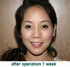 plastic-surgery-chin-augmentation