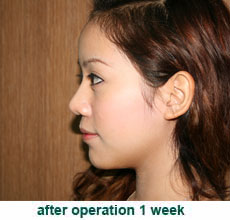 plastic-surgery-chin-augmentation