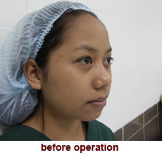 plastic-surgery-chin-augmentation