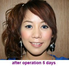 plastic-surgery-chin-augmentation