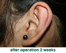 plastic-surgery-keloid-excision