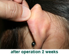 plastic-surgery-keloid-excision