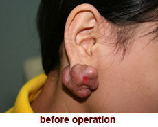 plastic-surgery-keloid-excision