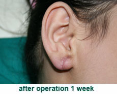 plastic-surgery-keloid-excision