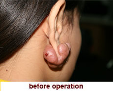 plastic-surgery-keloid-excision