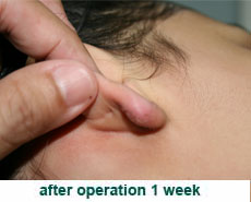 plastic-surgery-keloid-excision