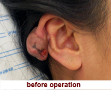 plastic-surgery-keloid-excision