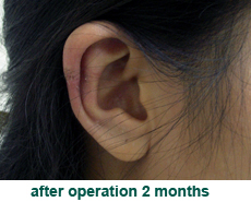 plastic-surgery-keloid-excision