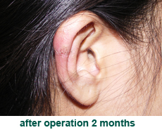 plastic-surgery-keloid-excision