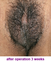 plastic-surgery-labiaplasty