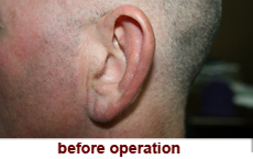 plastic-surgery-prominent-ear 