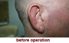 plastic-surgery-prominent-ear 