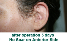 plastic-surgery-prominent-ear 