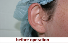 plastic-surgery-prominent-ear 