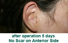 plastic-surgery-prominent-ear 