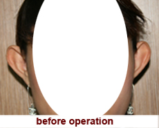 plastic-surgery-prominent-ear 