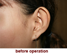 plastic-surgery-prominent-ear 