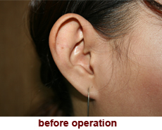 plastic-surgery-prominent-ear 