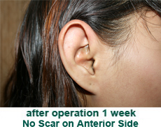 plastic-surgery-prominent-ear 